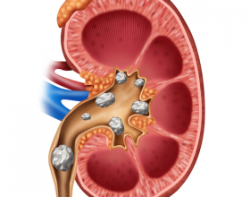 Sỏi thận có gây rối loạn cương dương?
